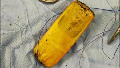 Photo of A mobile phone hidden in the patient’s abdomen 6 months ago was found