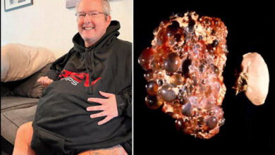Photo of A 77-pound kidney was removed from the patient’s body